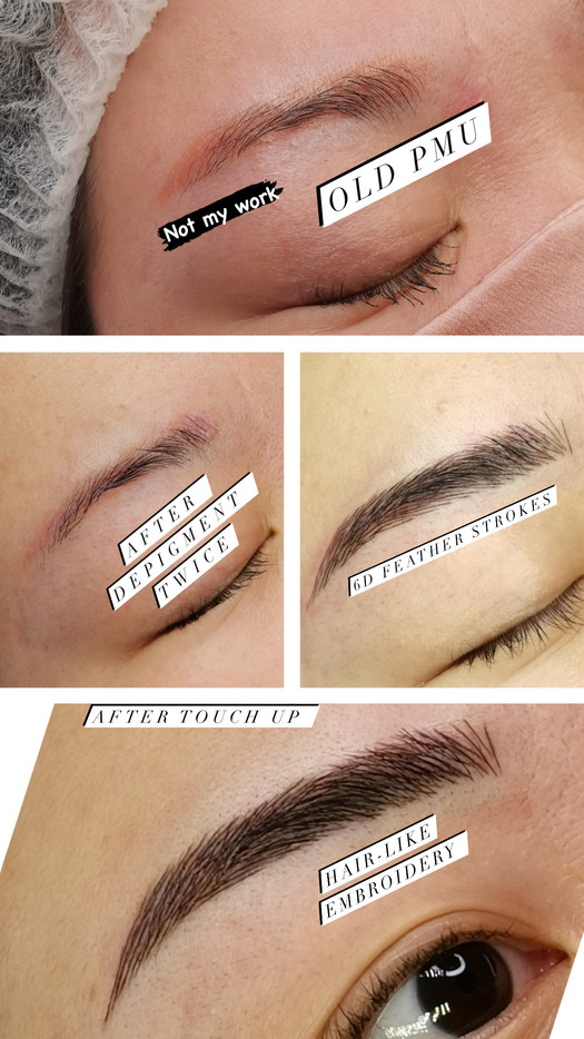 Old Embroidery/Tattoo Removal